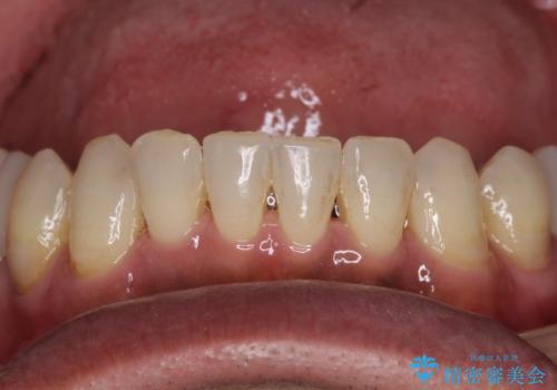歯列不正と歯周病 総合歯科治療による全顎治療の治療後