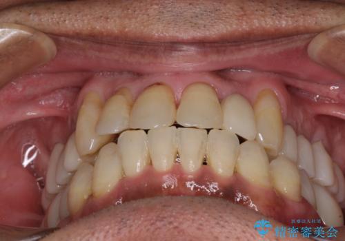 歯列不正と歯周病 総合歯科治療による全顎治療の治療後