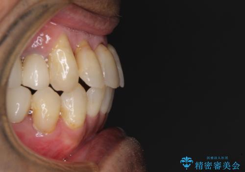 歯列不正と歯周病 総合歯科治療による全顎治療の治療後