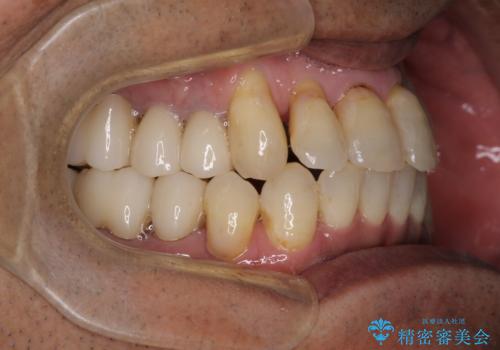 歯列不正と歯周病 総合歯科治療による全顎治療の治療後