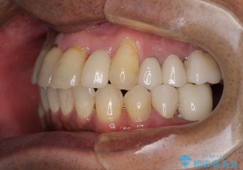 歯列不正と歯周病 総合歯科治療による全顎治療の治療後