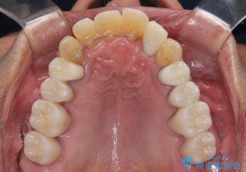 歯列不正と歯周病 総合歯科治療による全顎治療の治療後