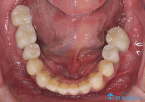 歯列不正と歯周病 総合歯科治療による全顎治療の治療後
