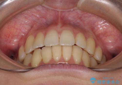 インビザラインでスッキリとした口元にの治療後