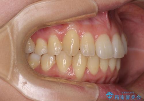 インビザラインでスッキリとした口元にの治療後