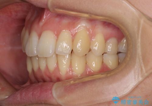 インビザラインでスッキリとした口元にの治療後