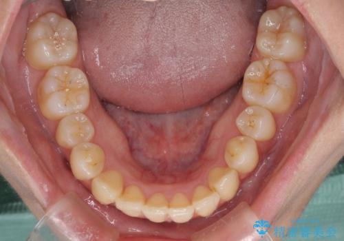 インビザラインでスッキリとした口元にの治療後