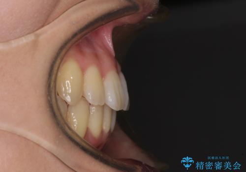 インビザラインでスッキリとした口元にの治療後
