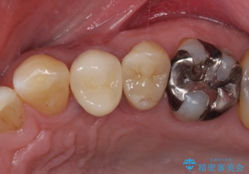割れてしまった小臼歯 インプラントによる補綴治療の治療後