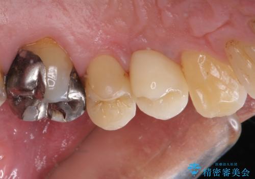 割れてしまった小臼歯 インプラントによる補綴治療の治療後
