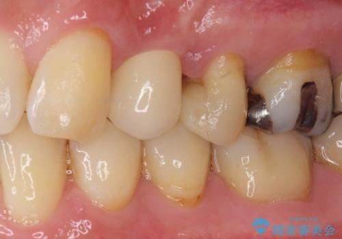 割れてしまった小臼歯 インプラントによる補綴治療の治療後