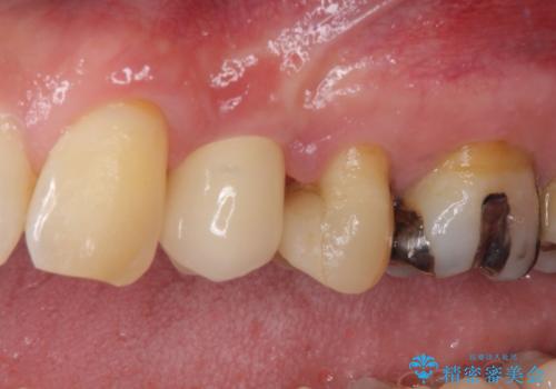 割れてしまった小臼歯 インプラントによる補綴治療の治療後