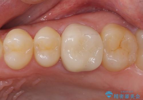 他院で神経を取ると言われた 神経を極力残した虫歯治療の症例 治療後