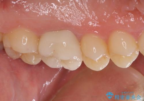 他院で神経を取ると言われた 神経を極力残した虫歯治療の治療後