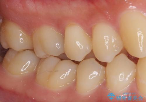 フロスが引っかかる セラミックインレーによるむし歯治療の治療前