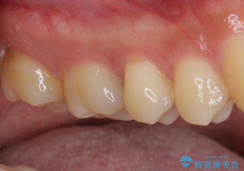 フロスが引っかかる セラミックインレーによるむし歯治療の治療前