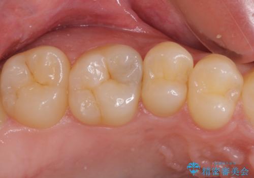 フロスが引っかかる　セラミックインレーによるむし歯治療の症例 治療前