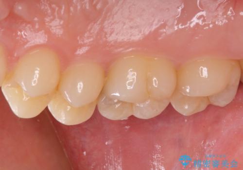 フロスが引っかかる セラミックインレーによるむし歯治療の治療前