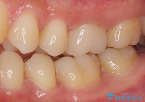 他院で神経を取ると言われた 神経を極力残した虫歯治療の治療後
