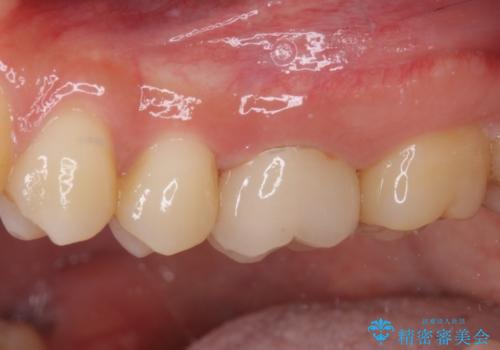 他院で神経を取ると言われた 神経を極力残した虫歯治療の治療後