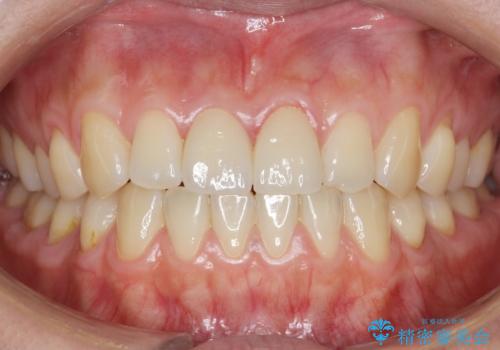 歯が折れた セラミックで綺麗に 30代女性の治療後