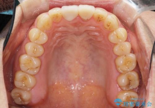 歯が折れた セラミックで綺麗に 30代女性の治療後