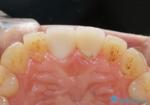 歯が折れた セラミックで綺麗に 30代女性の治療後