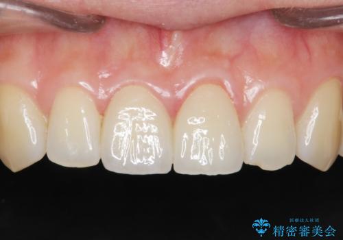 歯が折れた セラミックで綺麗に 30代女性の症例 治療後