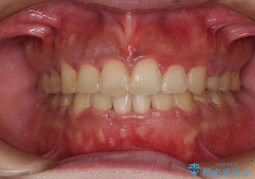 口元の突出感を改善　ワイヤー装置による抜歯矯正
