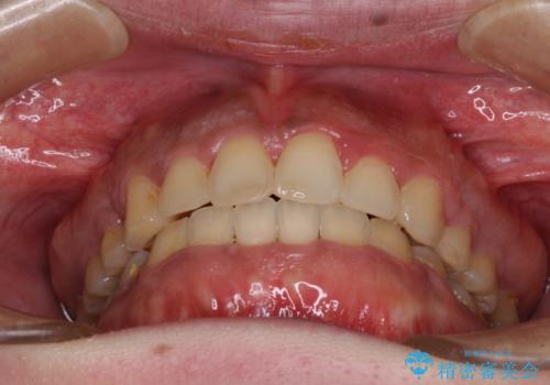 口元の突出感を改善 ワイヤー装置による抜歯矯正の治療後