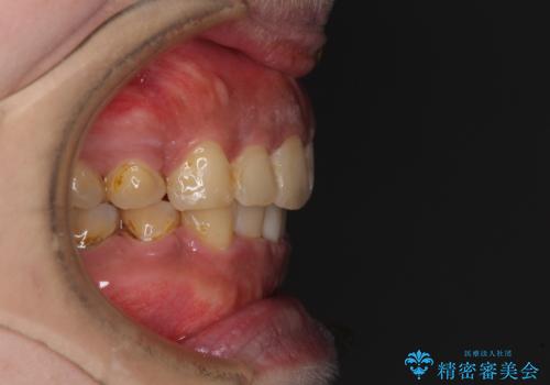 口元の突出感を改善 ワイヤー装置による抜歯矯正の治療後