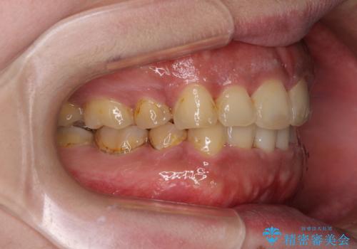 口元の突出感を改善 ワイヤー装置による抜歯矯正の治療後