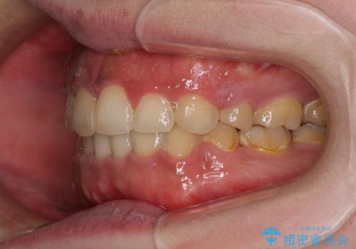 口元の突出感を改善 ワイヤー装置による抜歯矯正の治療後