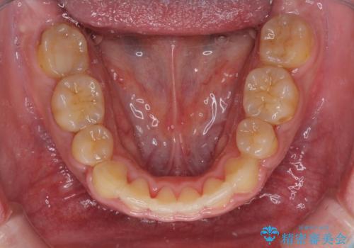 口元の突出感を改善　ワイヤー装置による抜歯矯正の治療後