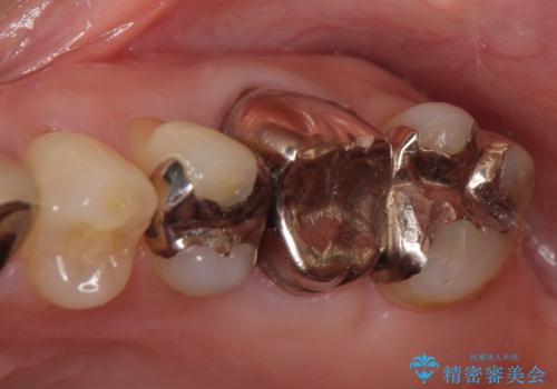 オールセラミッククラウン 抜歯になった奥歯の欠損補綴の治療前