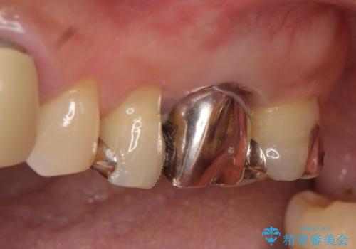 オールセラミッククラウン 抜歯になった奥歯の欠損補綴の症例 治療前