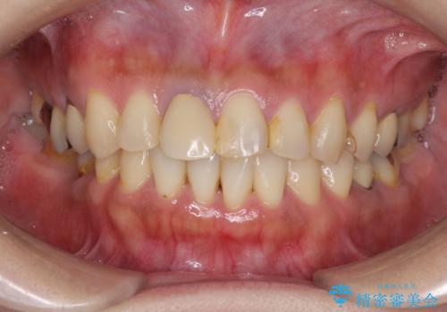 気になる部分を全て治療　総合歯科治療で口腔内環境改善の症例 治療前