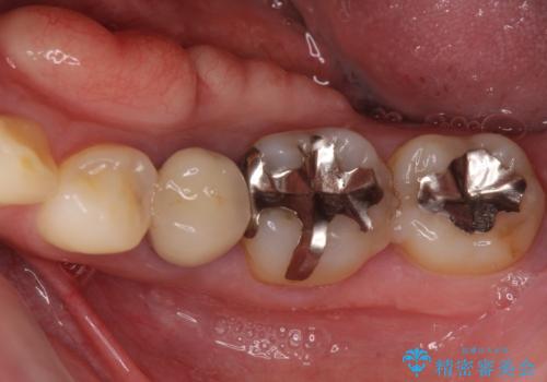 気になる部分を全て治療　総合歯科治療で口腔内環境改善の治療前