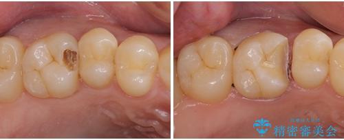 フロスが引っかかる セラミックインレーによるむし歯治療の治療中