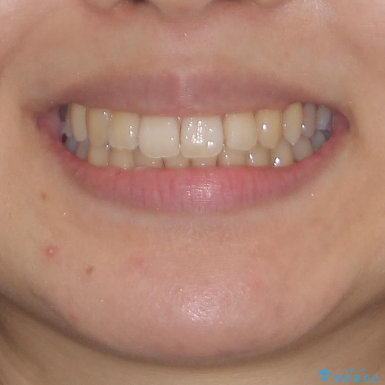 インビザラインでスッキリとした口元にの治療後(顔貌)