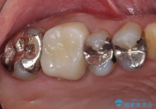 痛くてかめない 根管治療とオールセラミッククラウン