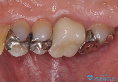 痛くてかめない 根管治療とオールセラミッククラウンの治療後