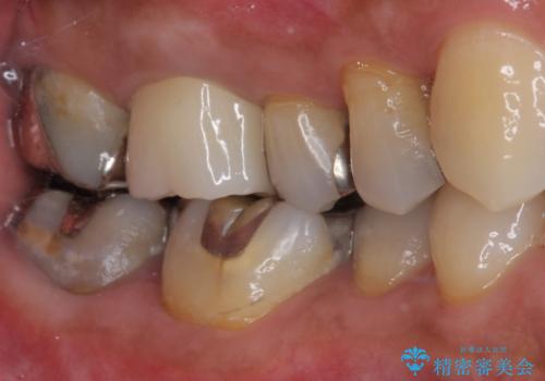 痛くてかめない 根管治療とオールセラミッククラウンの治療後