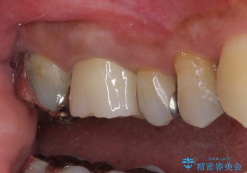 痛くてかめない 根管治療とオールセラミッククラウンの治療後