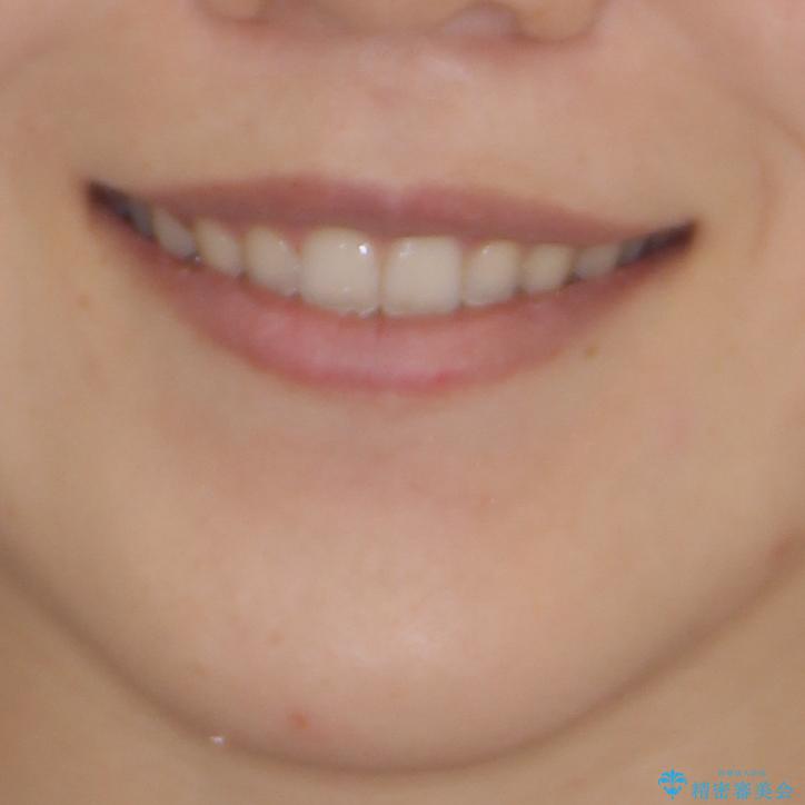 気になる隙間の再矯正 前歯をインビザライン・ライトで改善の治療後(顔貌)