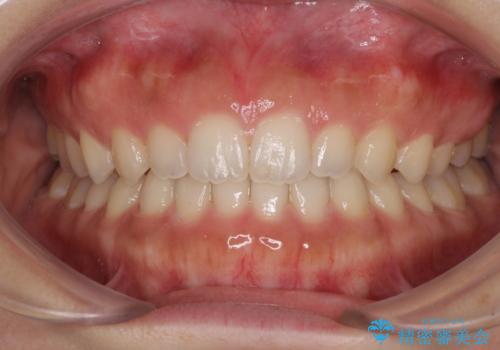 気になる隙間の再矯正　前歯をインビザライン・ライトで改善の症例 治療後