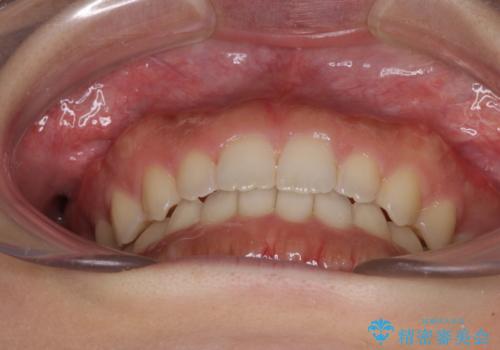 気になる隙間の再矯正　前歯をインビザライン・ライトで改善の治療後