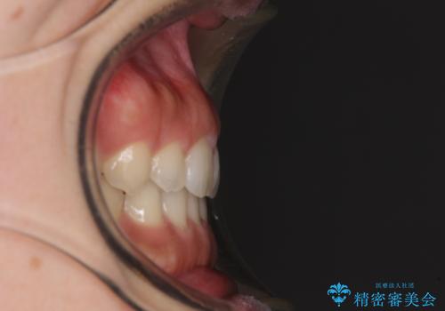 気になる隙間の再矯正 前歯をインビザライン・ライトで改善の治療後