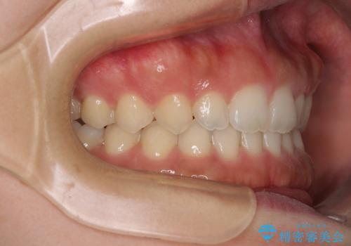 気になる隙間の再矯正　前歯をインビザライン・ライトで改善の治療後