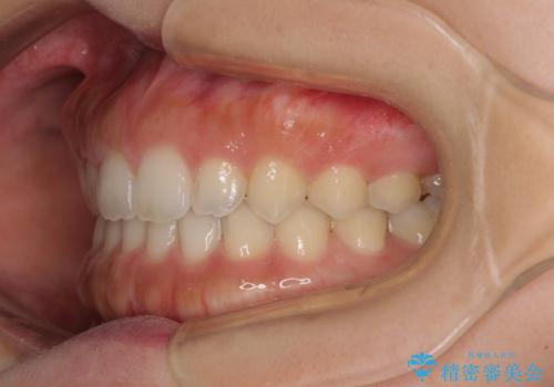 気になる隙間の再矯正 前歯をインビザライン・ライトで改善の治療後